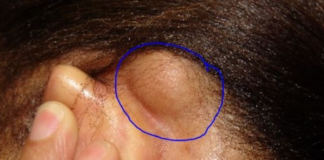 Lump behind Ear