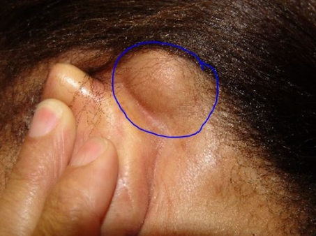 Lump behind Ear